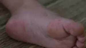 Bệnh tay chân miệng và sốt xuất huyết gia tăng mạnh tại Cần Thơ