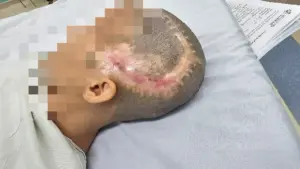 Cô gái 33 tuổi đột quỵ sau khi bơm mỡ tự thân vào vùng thái dương làm đẹp