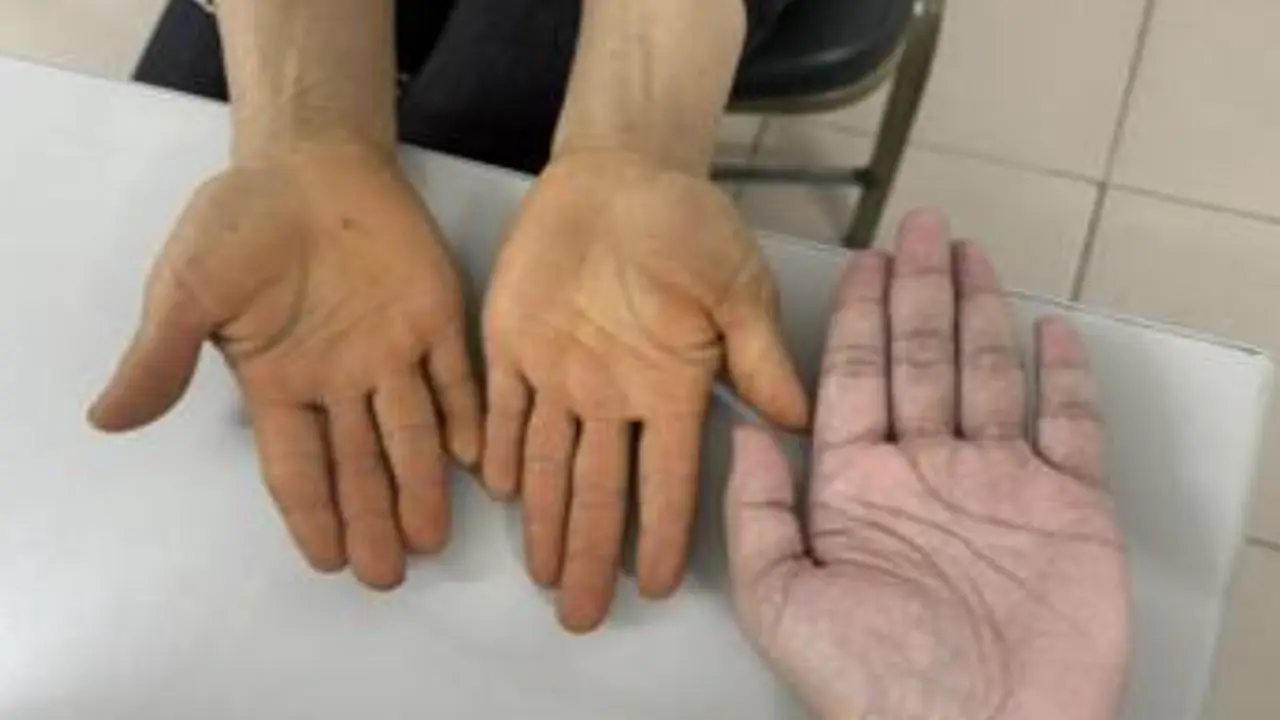 Không mắc bệnh về gan, tại sao lòng bàn tay, bàn chân chuyển màu vàng?