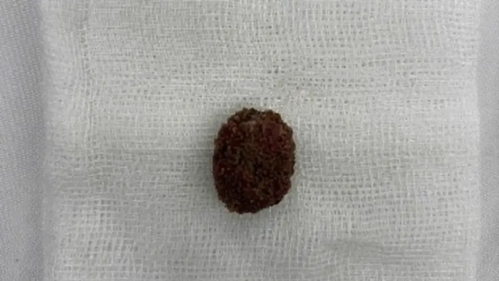 TP.HCM: Tin 'thuốc tan sỏi thận' trên mạng, người đàn ông tắc nghẽn đường niệu