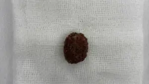 TP.HCM: Tin 'thuốc tan sỏi thận' trên mạng, người đàn ông tắc nghẽn đường niệu