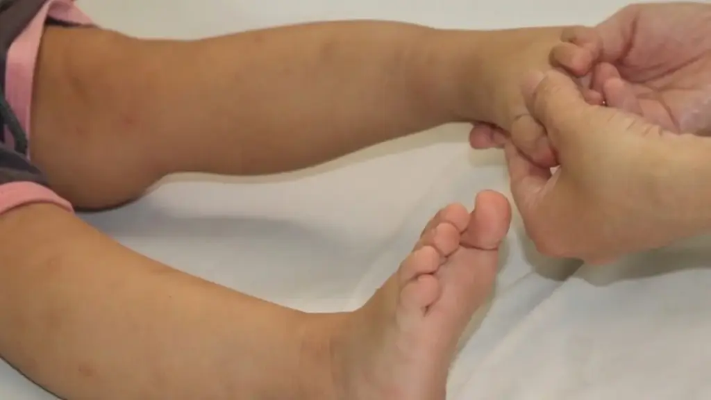 Trẻ nhiễm EV71 triệu chứng tay chân miệng mờ nhạt nhưng nặng nhanh