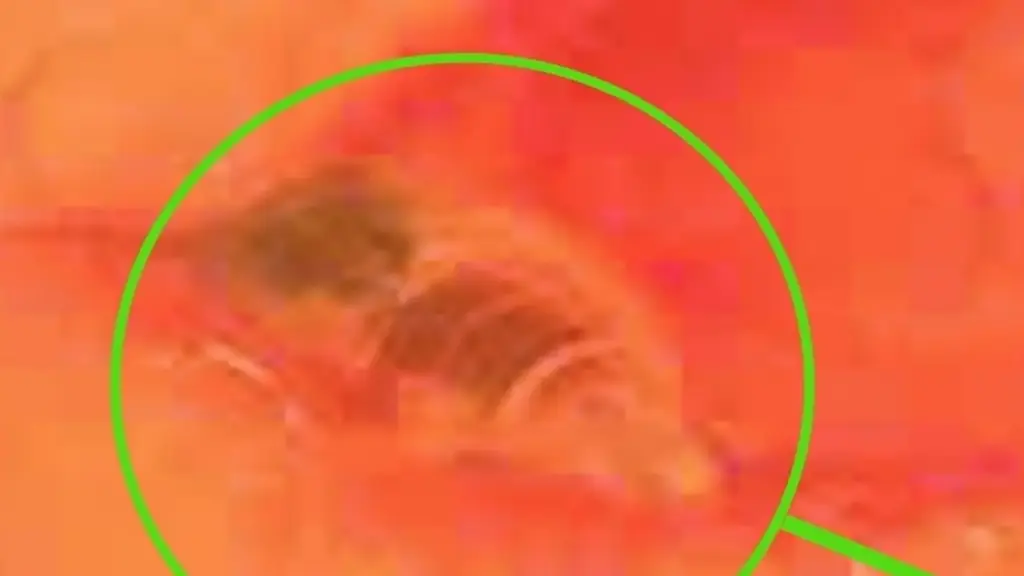 Xác ong kẹt 24 giờ trong mắt người phụ nữ