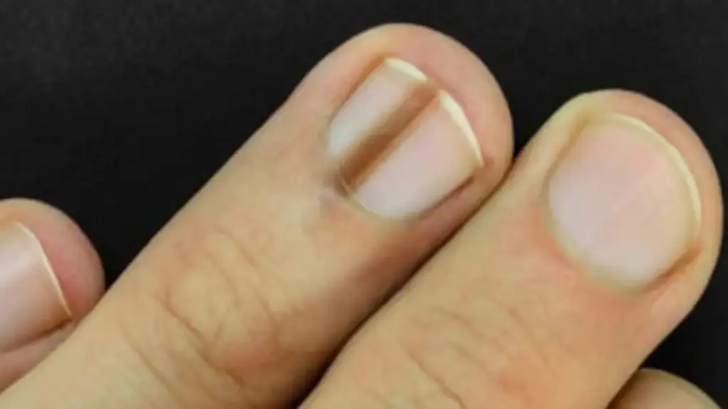 6 bất thường trên móng tay có thể đang “tố cáo” bệnh trong cơ thể bạn