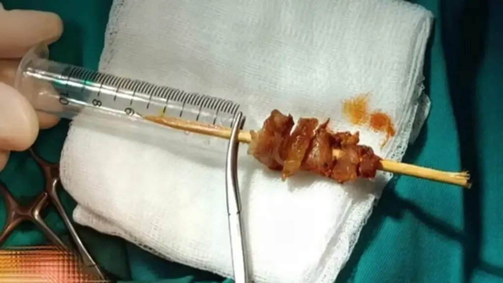 Bé 2 tuổi gặp sự cố nguy hiểm với que xiên thịt trong lúc chạy nhảy