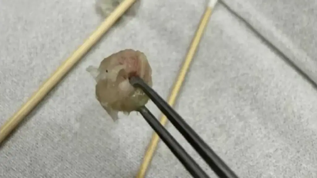 Bé gái 6 tuổi nhập viện khẩn cấp, bố mẹ "sốc" khi bác sĩ lấy ra thứ "đáng sợ" từ mũi con