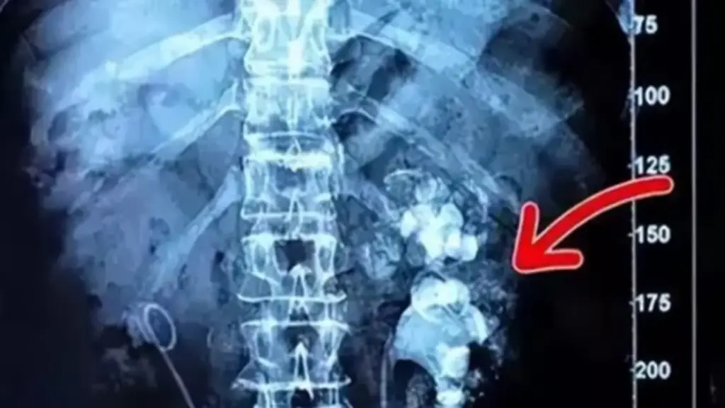 Cô gái trẻ nhập viện, bác sĩ phát hiện hai bên thận chi chít sỏi vì món đồ uống yêu thích