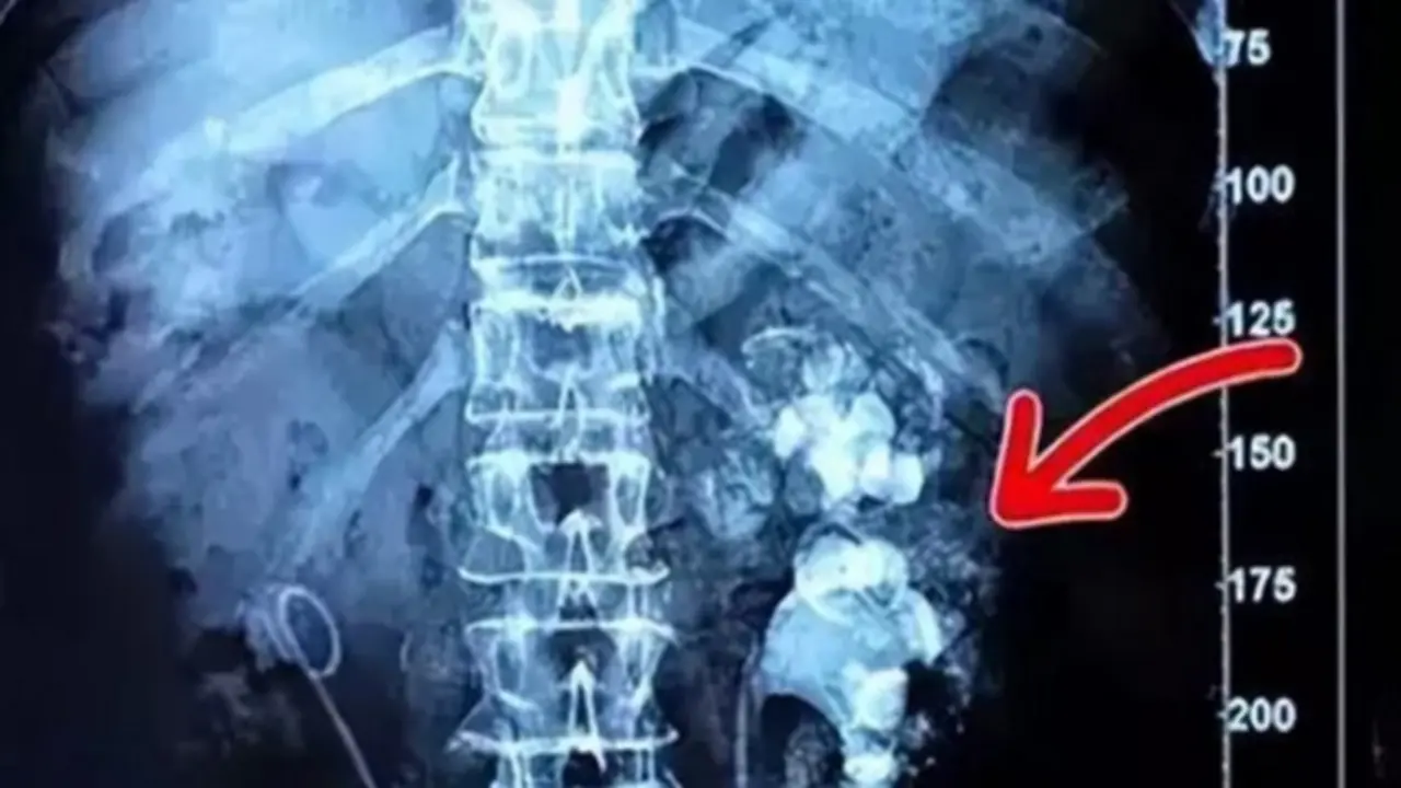 Cô gái trẻ nhập viện, bác sĩ phát hiện hai bên thận chi chít sỏi vì món đồ uống yêu thích