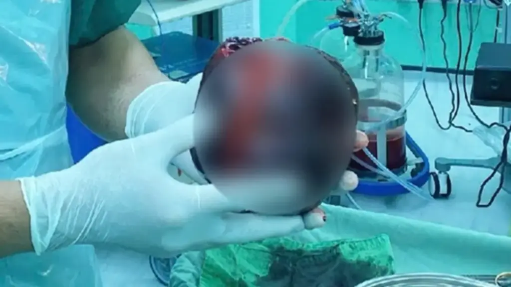 Đau bụng tưởng nhẹ, người đàn ông "sốc nặng" khi phát hiện thứ "đáng sợ" to bằng quả dưa lưới