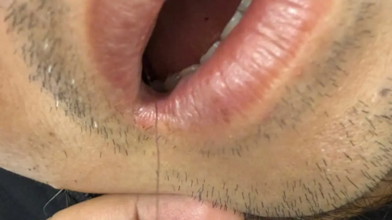 Hy hữu: Dây cước lộ ngoài miệng, bác sĩ nội soi gắp lưỡi câu khỏi thực quản