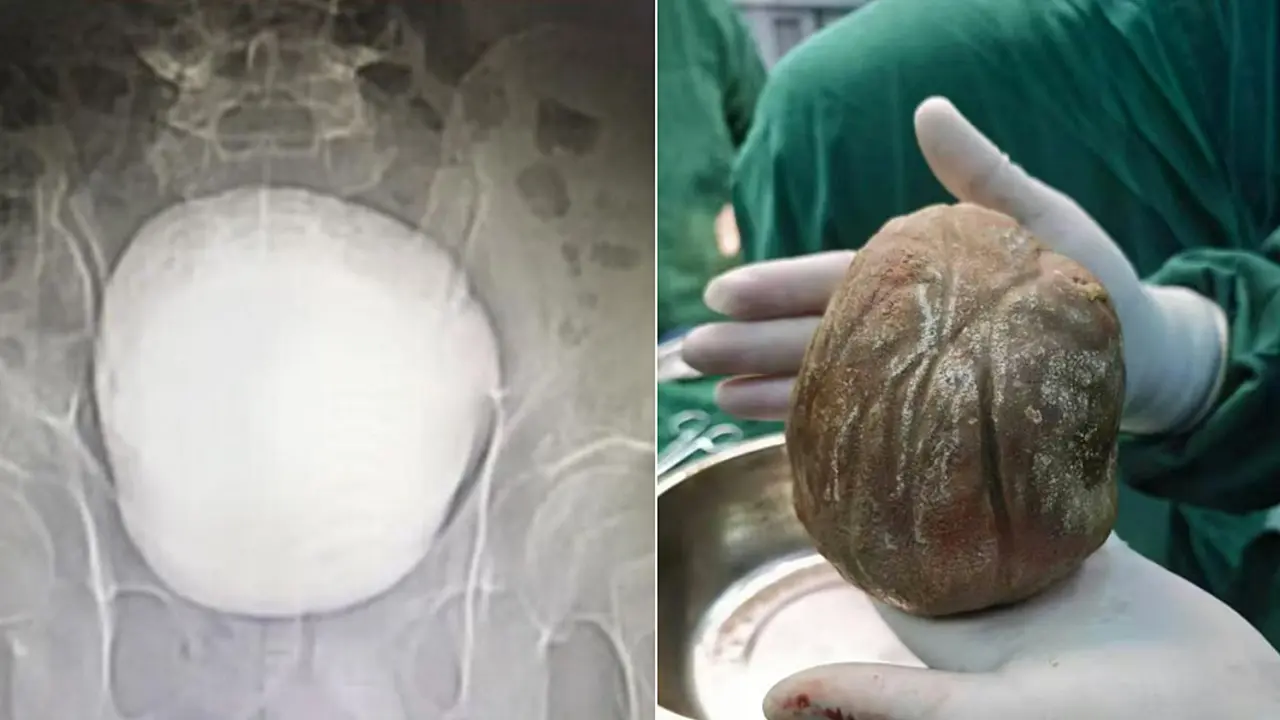 Khối sỏi bàng quang 1,3 kg khiến người đàn ông tiểu buốt suốt 3 năm