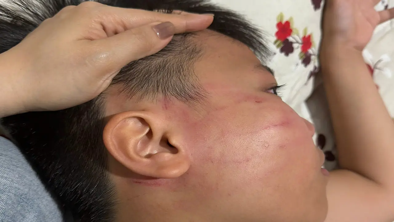 Nam sinh bầm mặt, ù tai sau buổi học thêm với thầy giáo ngoại