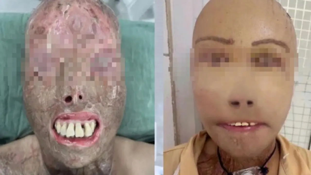 Ngã vào nồi nước sôi và hành trình 16 giờ 'trao trả' gương mặt