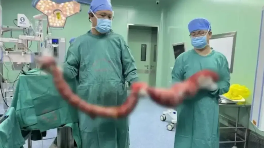 Người đàn ông 4 tháng không đi đại tiện, bụng phình to như "mang thai", bác sĩ lấy ra thứ "đáng sợ"