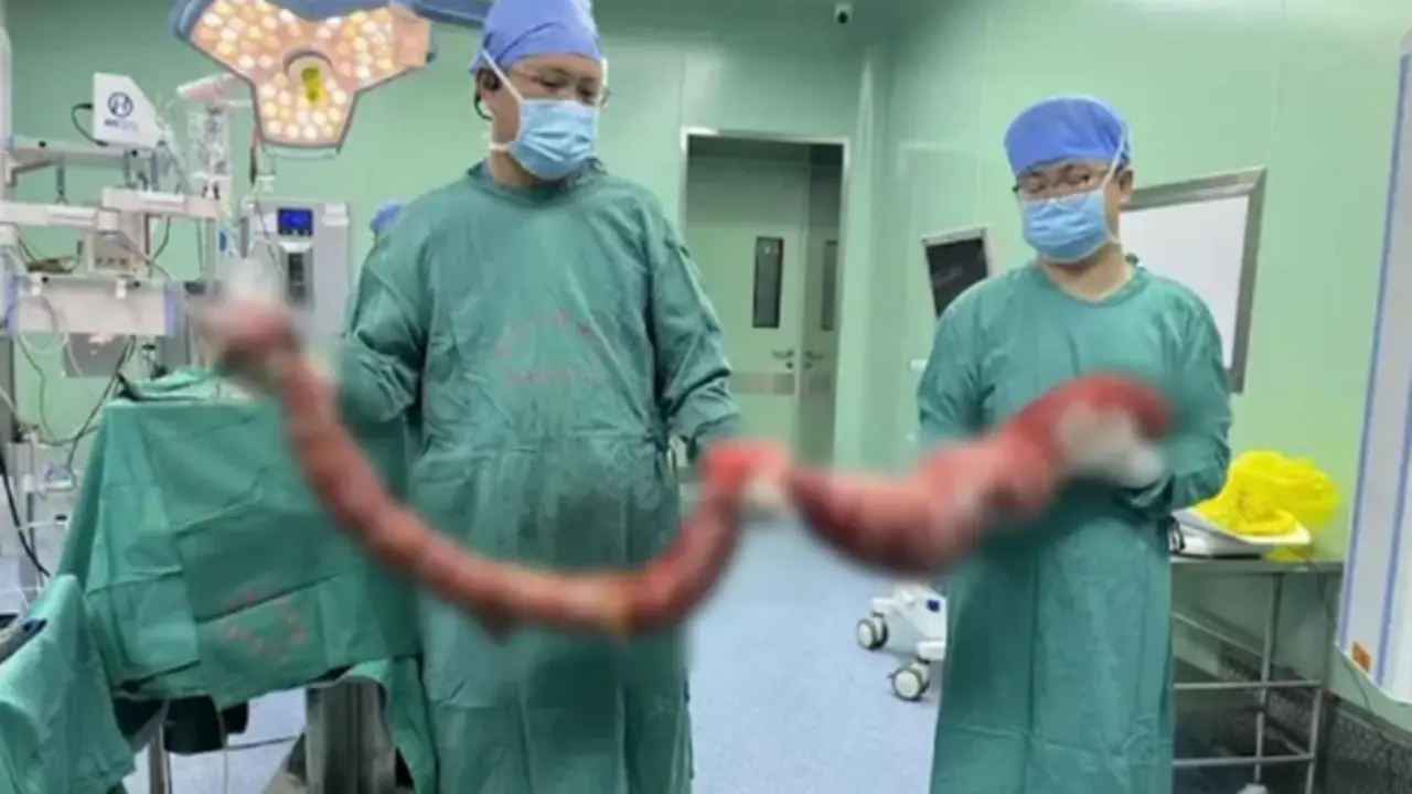 Người đàn ông 4 tháng không đi đại tiện, bụng phình to như "mang thai", bác sĩ lấy ra thứ "đáng sợ"