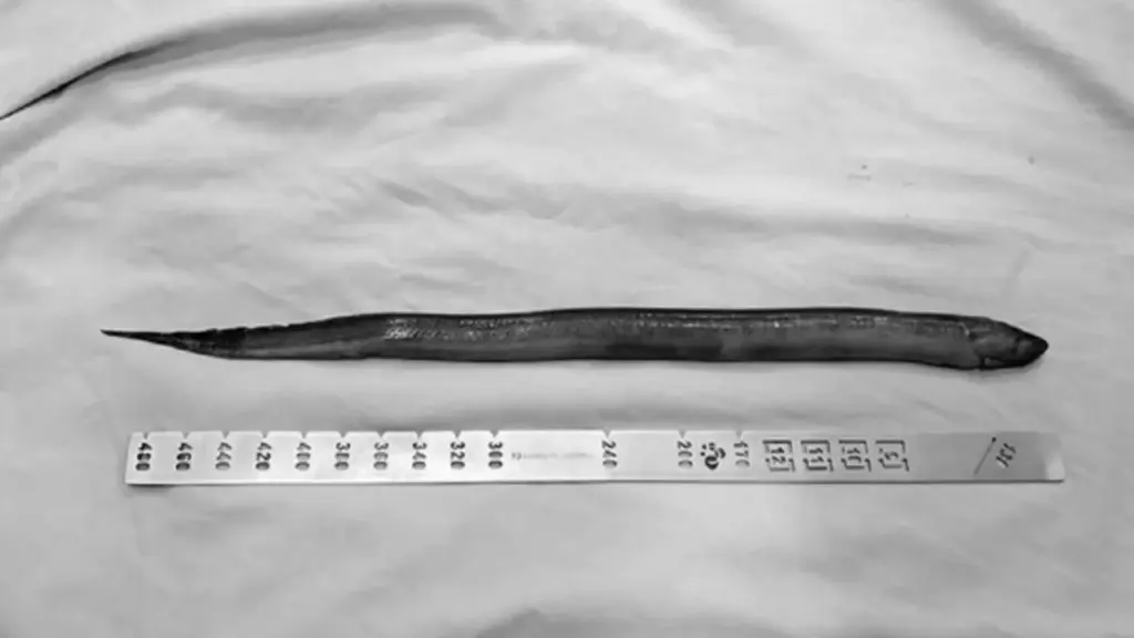 Người đàn ông 41 tuổi đau dữ dội, bác sĩ "sốc ngang" thấy con lươn dài 50cm trong bụng