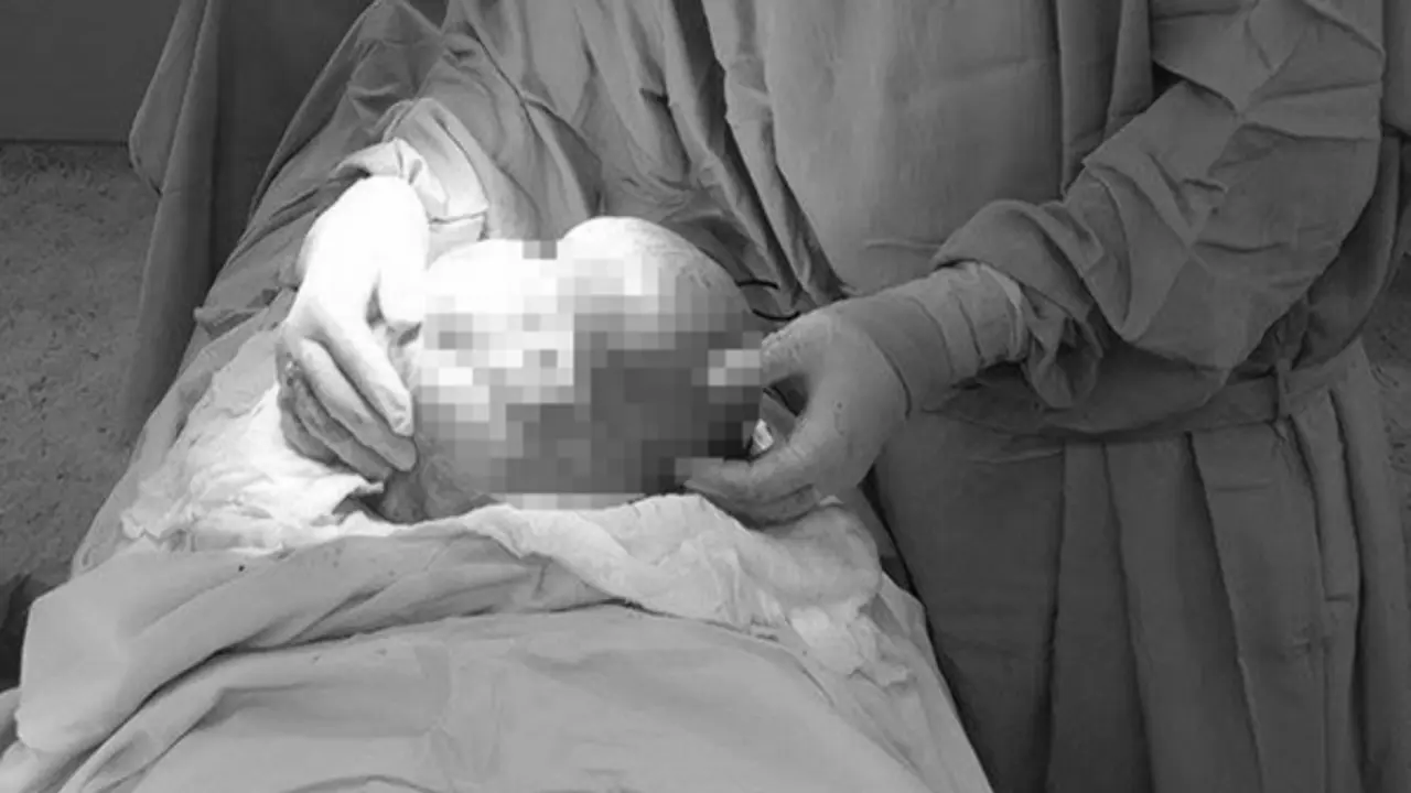 Người phụ nữ 42 tuổi bụng to bất thường, bác sĩ phát hiện thứ "đáng sợ" 3kg bên trong