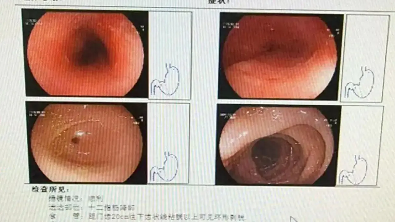 Người phụ nữ loét thực quản 8 cm vì nuốt vội thức ăn trong nồi lẩu