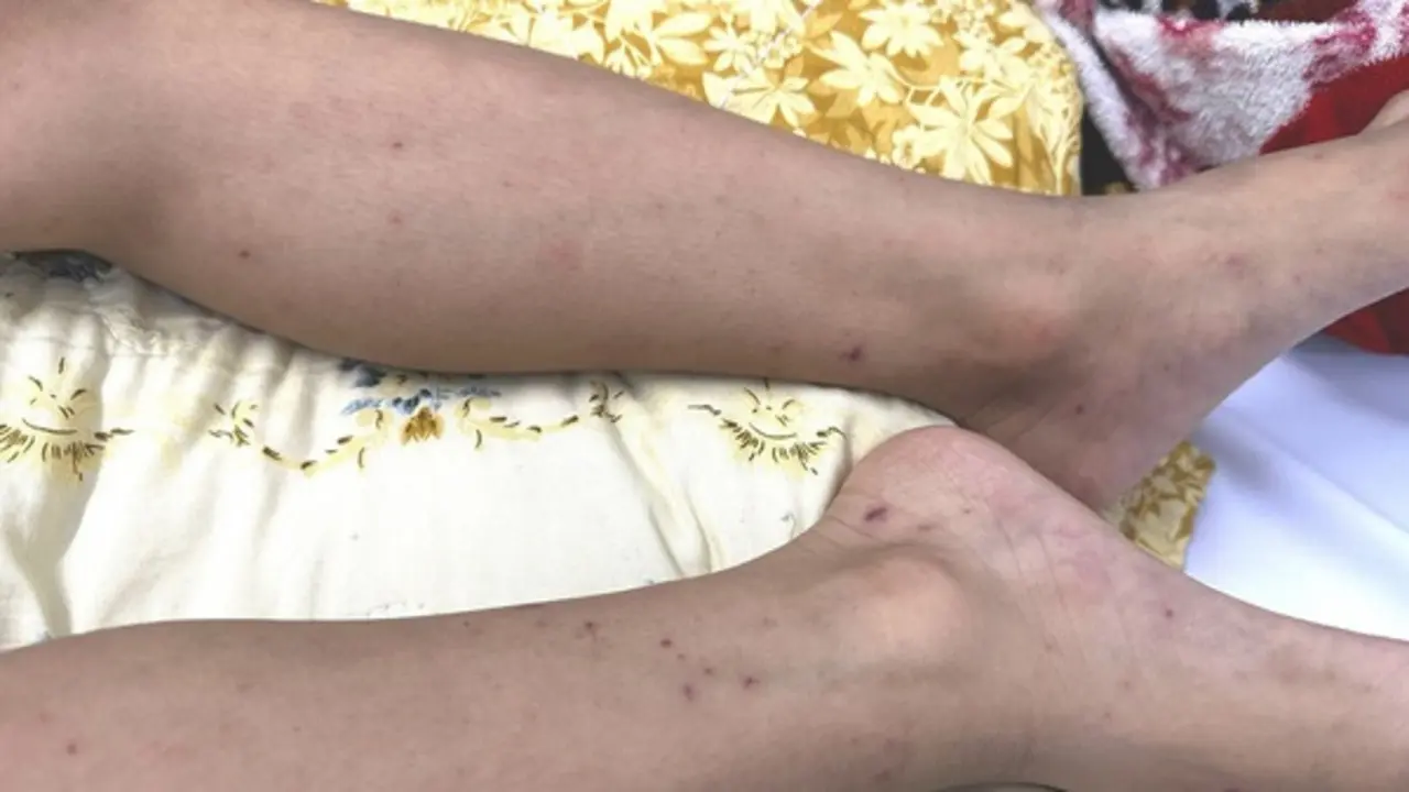 TP.HCM: Cứu sống bé trai 7 tuổi mắc não mô cầu