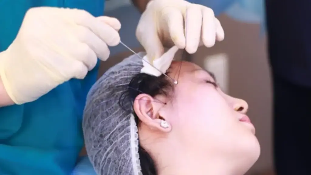 Trào lưu tự căng da mặt tại nhà gây sốc: Nhiều cô gái đối mặt nguy cơ hủy hoại gương mặt
