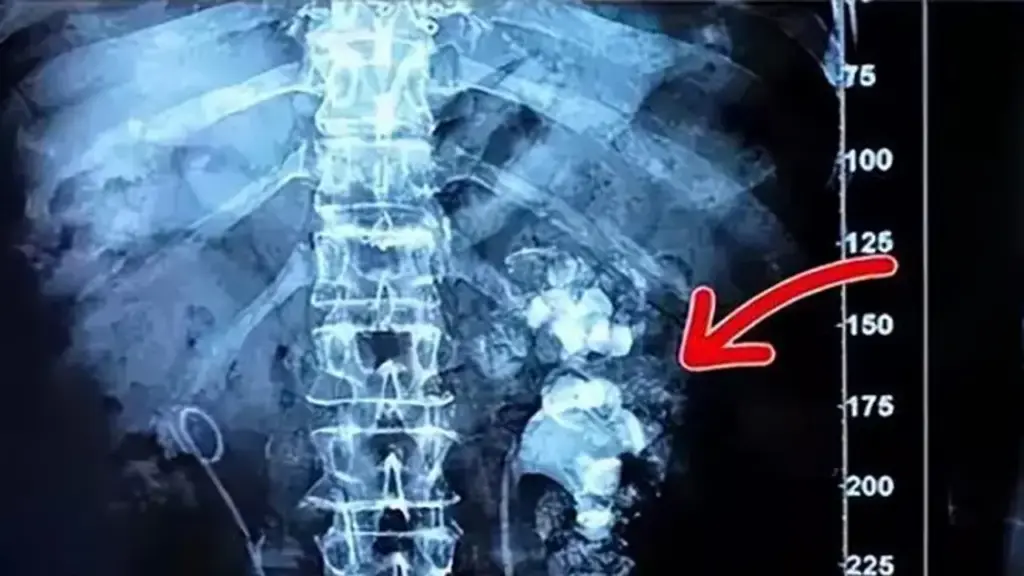Uống 3.000 cốc trà sữa thay nước lọc, thận cô gái mọc chi chít sỏi