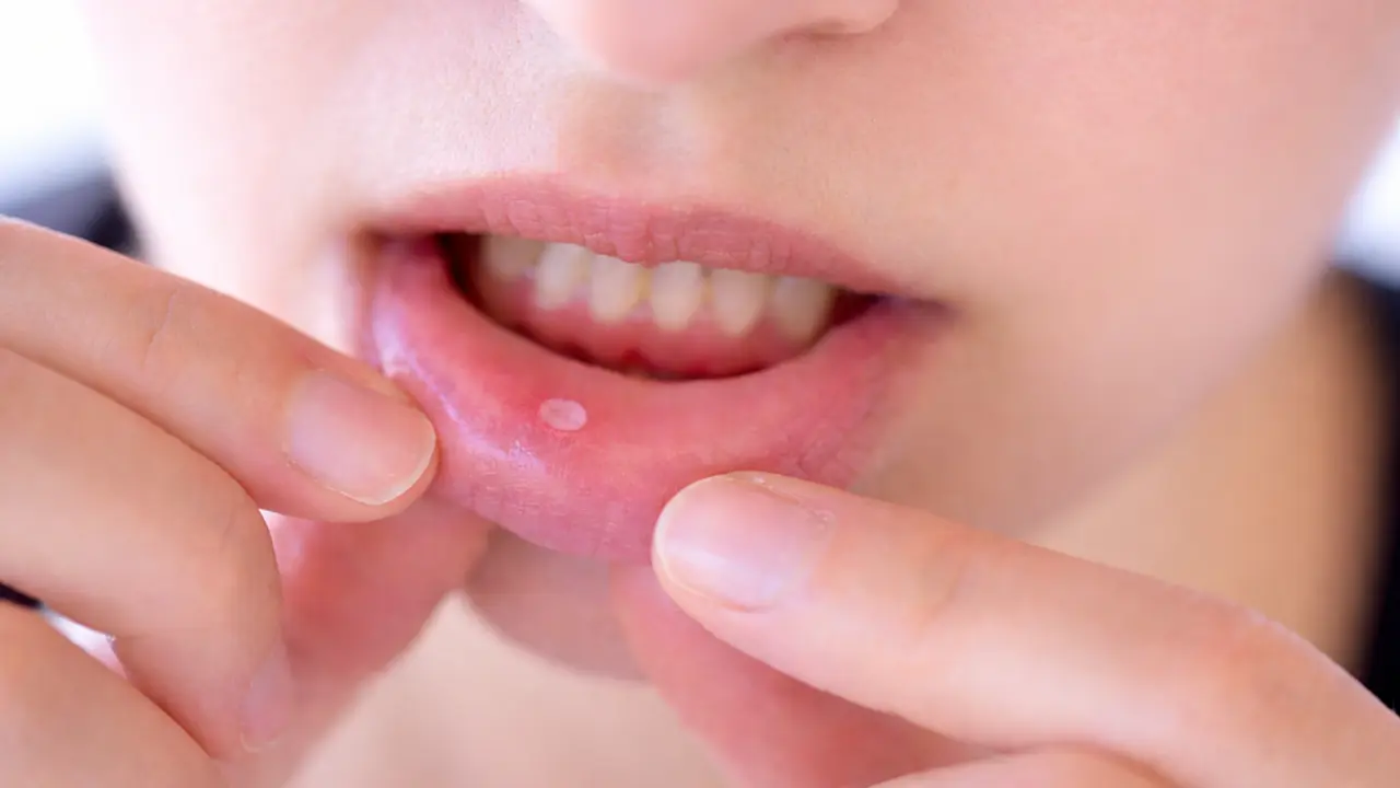 Vì sao không hút thuốc vẫn ung thư miệng?