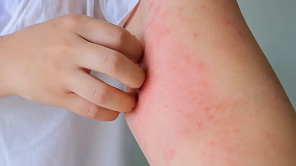 Vì sao không nuôi chó mèo vẫn có thể mắc giun đũa chó mèo?