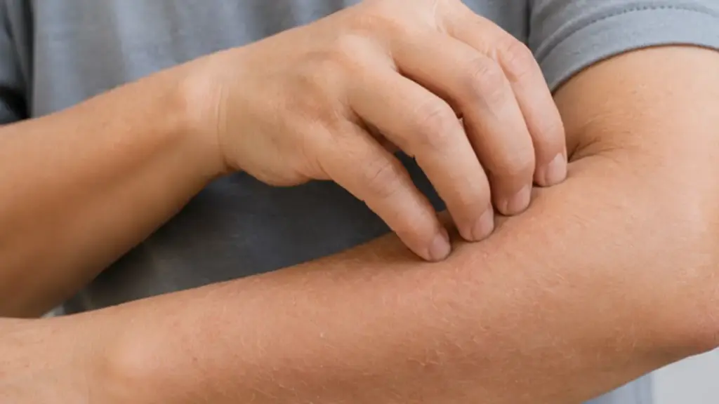 4 dấu hiệu trên da cảnh báo bệnh thận