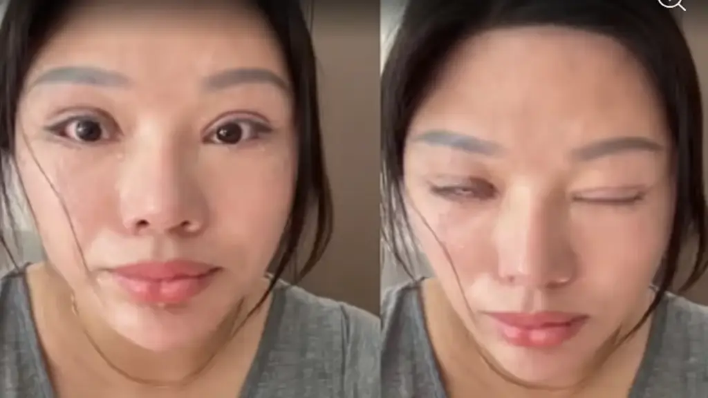 6 năm không thể nhắm mắt vì cắt mí hỏng