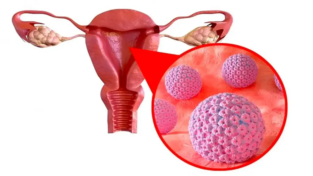 Bác sĩ chỉ cách nhận diện sớm ung thư cổ tử cung và buồng trứng