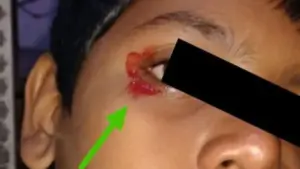 Bé trai 11 tuổi khóc ra máu khiến bác sĩ kinh ngạc