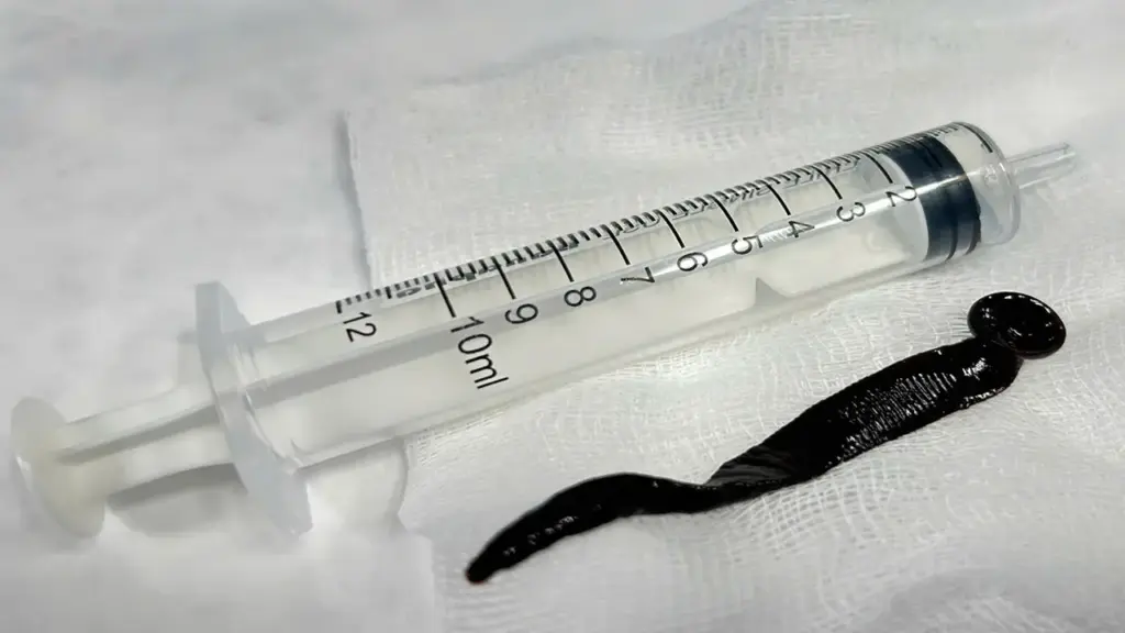 Con đỉa 12 cm sống trong đường thở bé trai