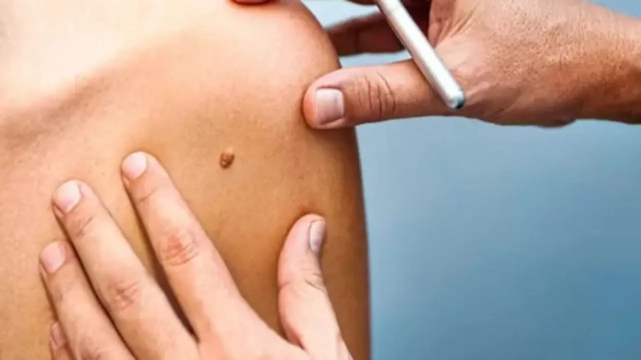Công bố nghiên cứu mới về nốt ruồi và nguy cơ ung thư hắc tố da