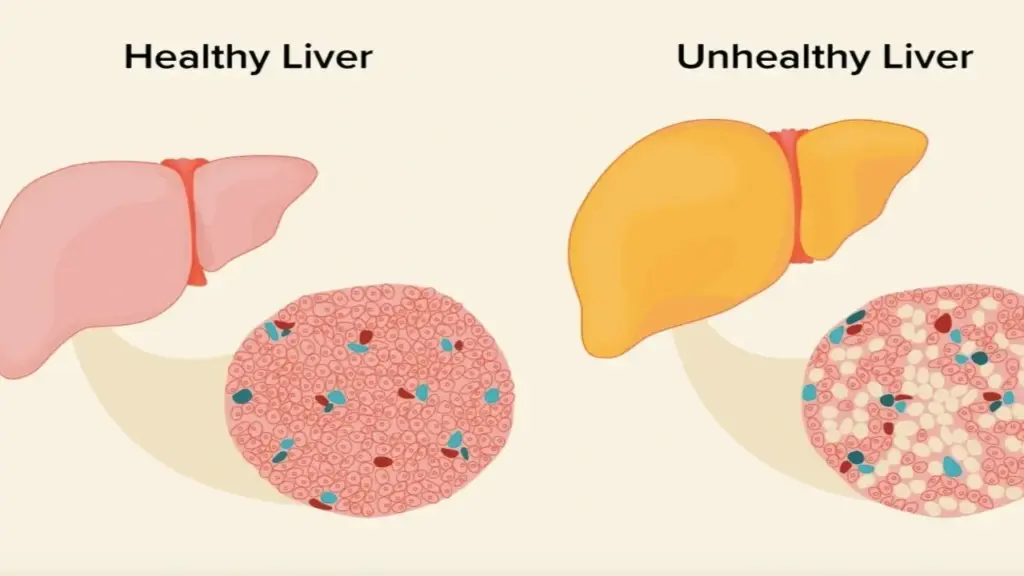 Dấu hiệu cảnh báo bệnh gan nhiễm mỡ do rối loạn chuyển hóa