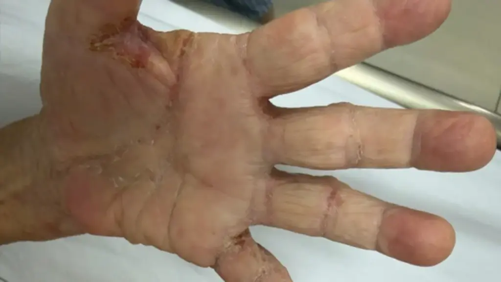 Một gia đình bị loài ký sinh trùng tưởng đã "biến mất" từ lâu tấn công