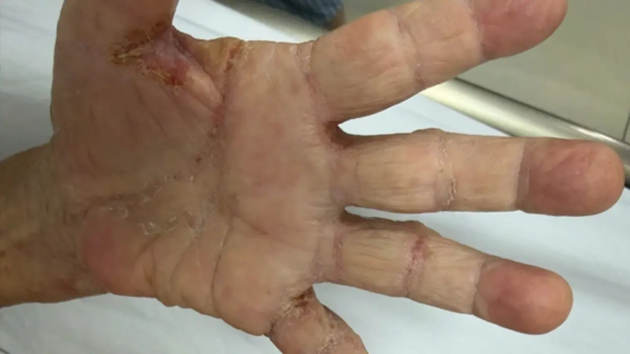 Một gia đình bị loài ký sinh trùng tưởng đã "biến mất" từ lâu tấn công