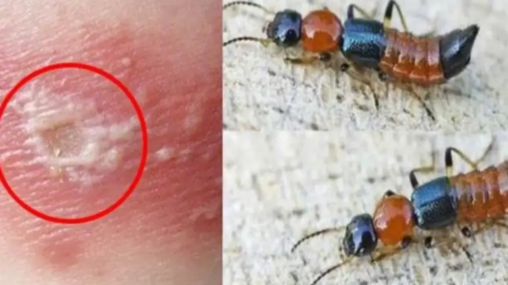 Những sai lầm phổ biến khi nhầm viêm da do kiến ba khoang với bệnh zona thần kinh