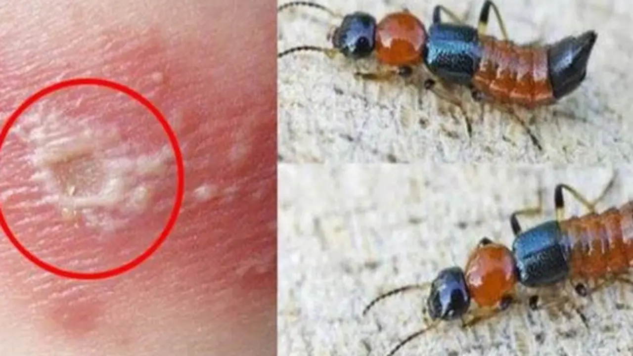 Những sai lầm phổ biến khi nhầm viêm da do kiến ba khoang với bệnh zona thần kinh