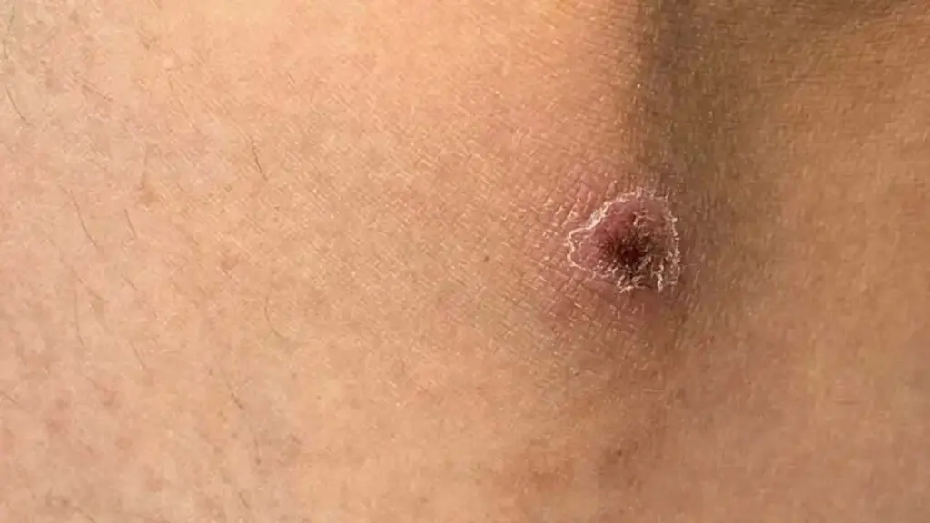Suy đa tạng do mò đốt
