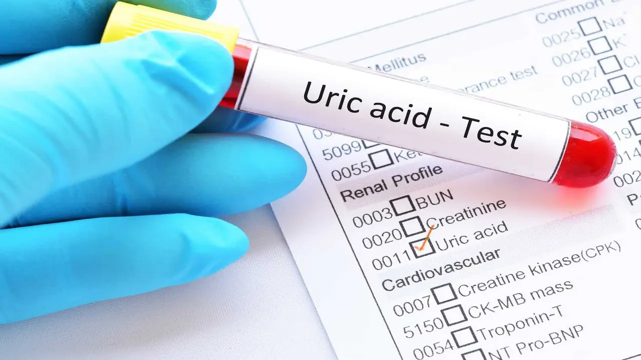 4 dấu hiệu cảnh báo axit uric tăng cao, nguy cơ sỏi thận