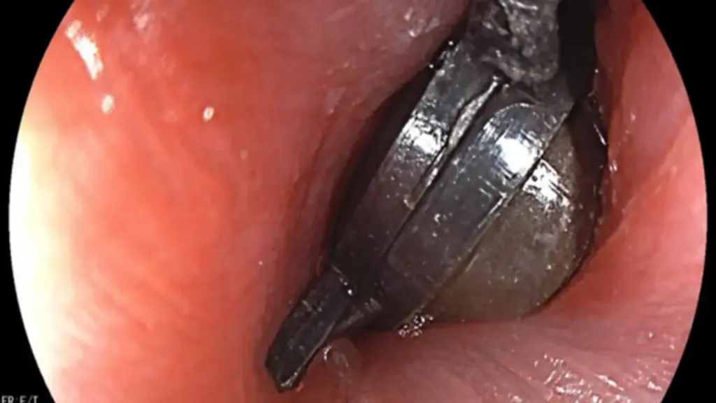 Bé 5 tuổi đau bụng dữ dội, bố mẹ sốc khi bác sĩ gắp ra thứ "đáng sợ" bên trong