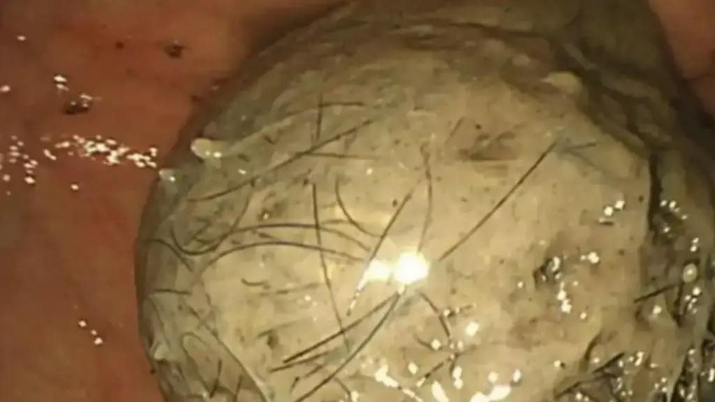 Bé gái 10 tuổi đau bụng suốt 3 năm, bố mẹ sốc khi bác sĩ lấy ra thứ "đáng sợ" trong bụng
