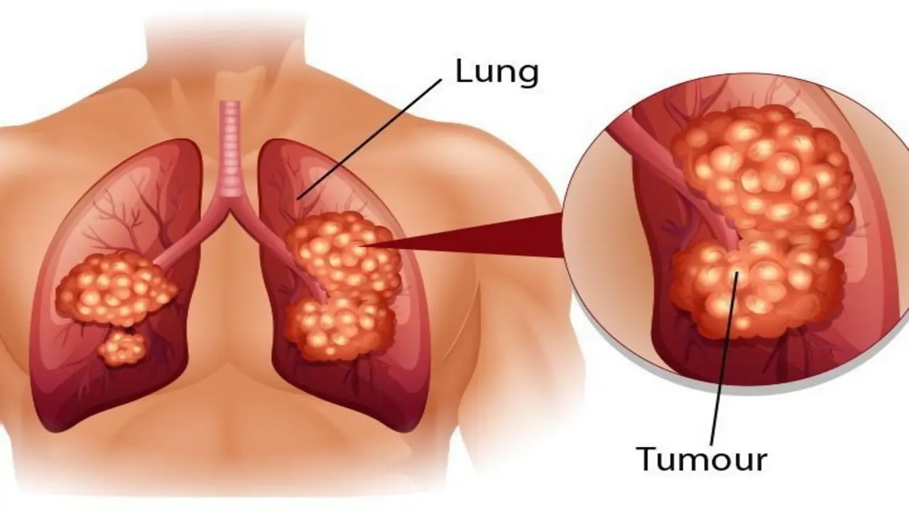 Cảnh báo sớm ung thư phổi qua những tín hiệu nhỏ của cơ thể