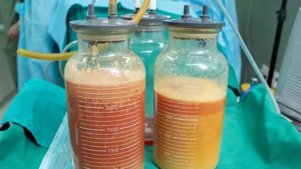 Hút ra gần 5 lít 'chất lạ' tồn tại 20 năm trong ngực người phụ nữ
