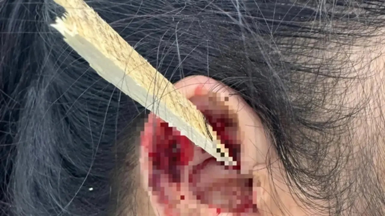 Mảnh gỗ dài 15 cm đâm xuyên tai nữ công nhân khi đang cưa gỗ