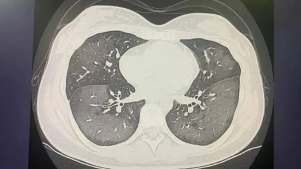 Nam tài xế 40 tuổi "phổi trắng xóa", bác sĩ cảnh báo thói quen "cực độc" nhiều người mê