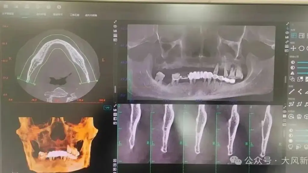 Người đàn ông đi khám chiếc răng đau nhưng bị nhổ cả hàm