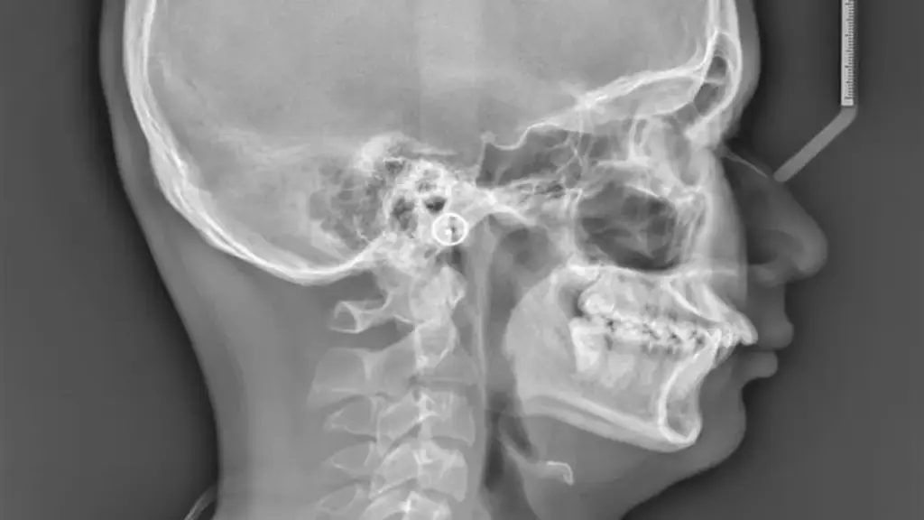 Tiếng ngáy ở trẻ em cảnh báo dấu hiệu không nên bỏ qua
