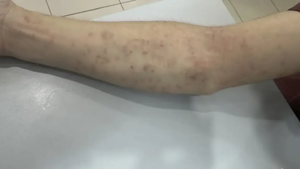Trị tận gốc viêm da mùa nắng nóng