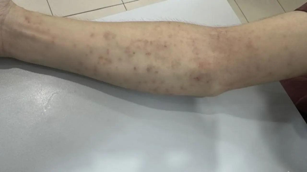 Trị tận gốc viêm da mùa nắng nóng